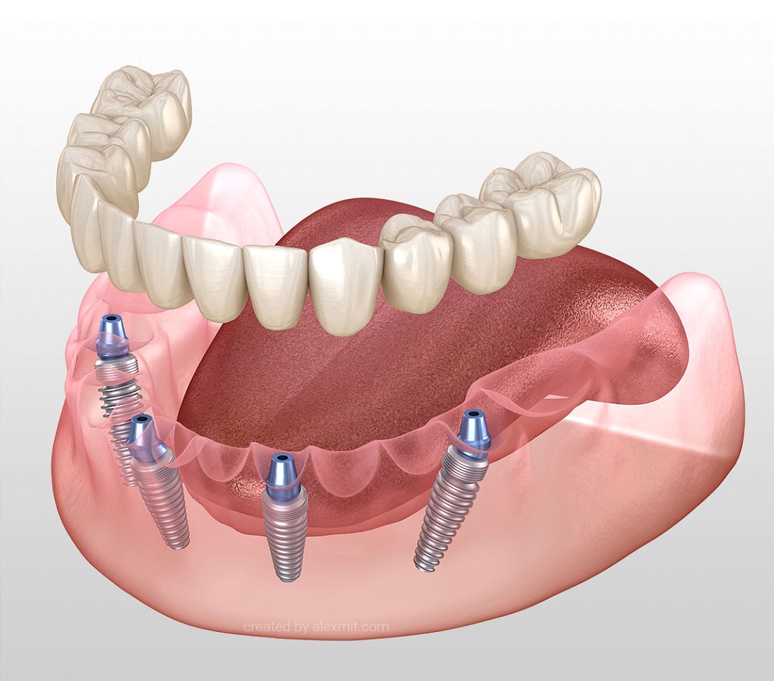 Mandibular prosthesis All on 4 system supported by implants. Medically accurate 3D illustration of human teeth and dentures concept